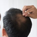 Alopecia en espaÃ±a