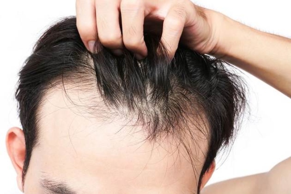 ¿Qué es alopecia difusa?