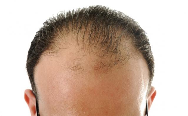 alopecia difusa