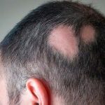alopecia prematura