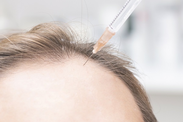 Hair Graft Without Shaving Your Head