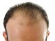 Calvo a meno di 30 anni: cosa posso fare?