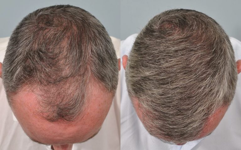 Evolution of the Hair Transplant in Stages - MyCapil ✔️