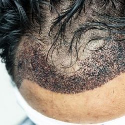 Qu'est-ce qu'une greffe de cheveux qui s'infecte?