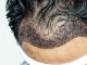 Qu'est-ce qu'une greffe de cheveux qui s'infecte