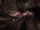 Psoriasi del cuoio capelluto: cause, sintomi e trattamenti