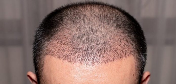Causes de la chute des cheveux chez les hommes