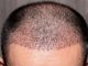 Causes de la chute des cheveux chez les hommes