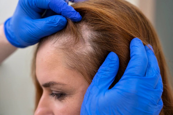 Hair Transplant on the Forehead in Women - MyCapil ✔️