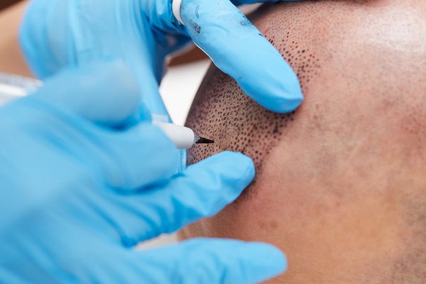 Capillary Tricopigmentation: Definition, Cost, and How it's Performed