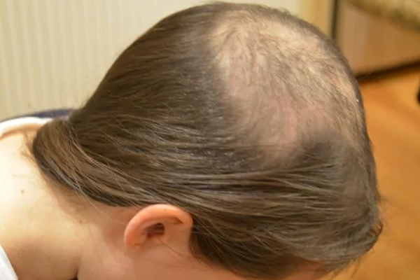 Compulsive Hair Pulling (Trichotillomania)