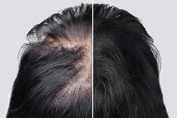 Stress-Induced Hair Loss (Telogen Effluvium)