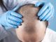 Hair Loss: Myths and Truths