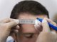 Tests To Diagnose Alopecia