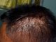 Seborrheic Alopecia
