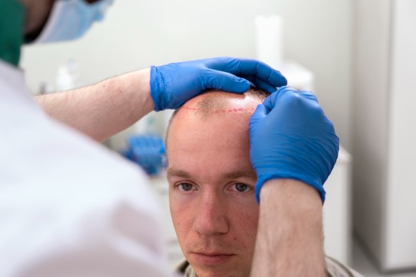 hair graft