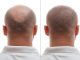 Pimples On The Scalp