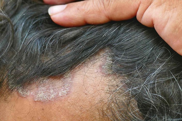 Causes of Seborrheic Alopecia