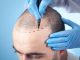 I 3 migliori medici per trapianti di capelli a Milano