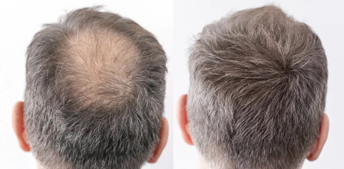 Hair colors to hide alopecia