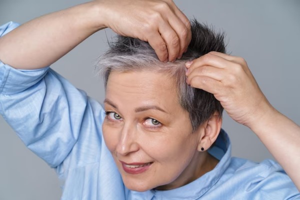 Female Aging Alopecia