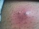 Avoid Ingrown Hair