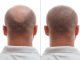 truths about Hair Transplantation