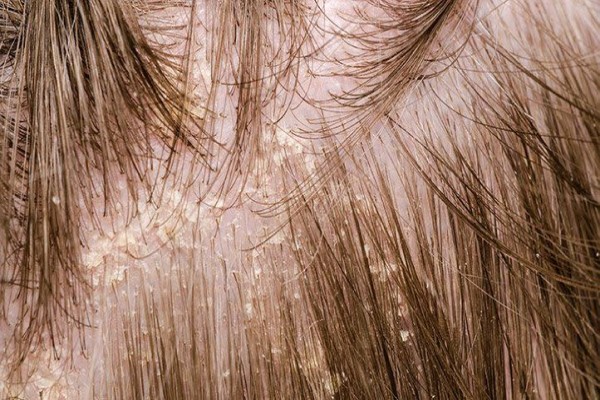 Alopecia
