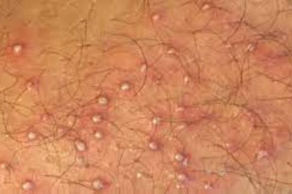 Inflamación purulenta de un folículo piloso