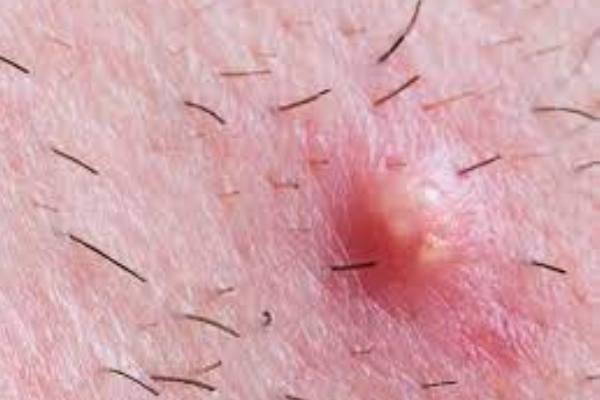 Inflamación purulenta de un folículo piloso
