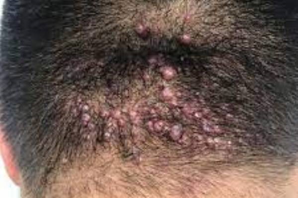 Inflamación purulenta de un folículo piloso