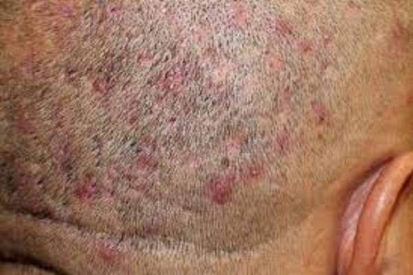 Inflamación purulenta de un folículo piloso