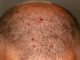 Inflamación purulenta de un folículo piloso