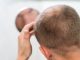 baldness and skin cancer