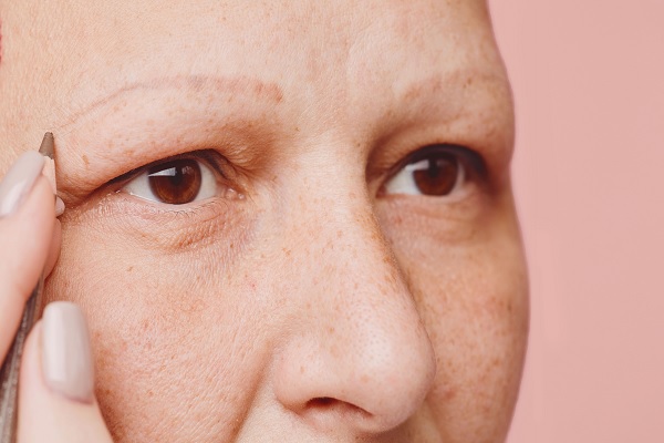 eyebrows alopecia