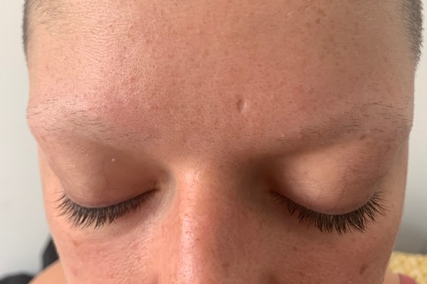 eyebrows alopecia